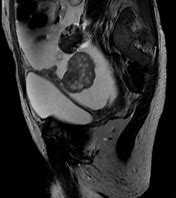 Image result for Krukenberg Tumor