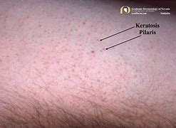 Image result for Keratosis Pilaris Chest