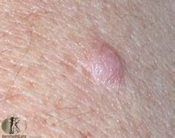 Image result for Flesh-Colored Skin Bumps On Face