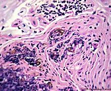 Image result for gemocromatosis