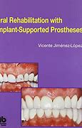 Image result for Dental Implant Supported Dentures