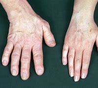 Image result for Acromegaly