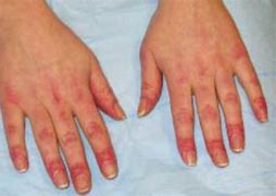 Image result for Small Red Dots On Hands