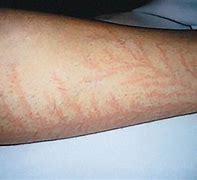 Image result for Electric Shock Scars