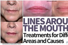 Image result for Lip Lines around Mouth