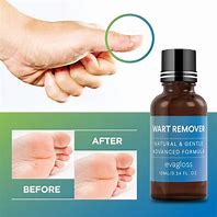 Image result for Topical Wart Treatment