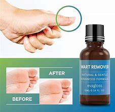 Image result for Wart Treatment Solution