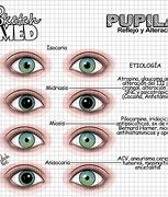 Image result for Pupilas Diferentes