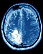 Image result for Migraine Brain Tumor