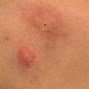 Image result for Mosquito Bites
