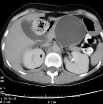 Image result for Cyst On Pancreas
