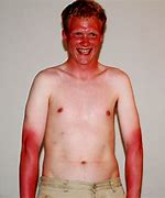 Image result for Hilarious Severe Sunburn