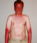 Image result for Sun Burn Purple Skin