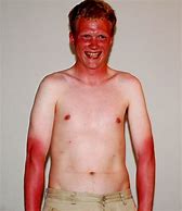 Image result for UVA Sun Burn