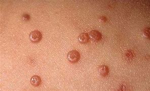 Image result for Vulvar Molluscum