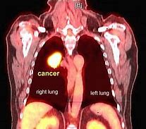 Image result for Pet Scan Lung