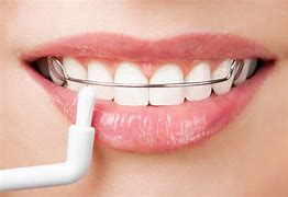 Image result for Dental Retainer
