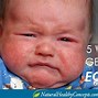 Image result for Atopic Dermatitis Baby