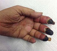 Image result for Rotting Finger