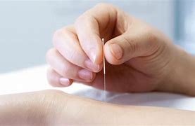 Image result for Chinese Medicine and Acupuncture