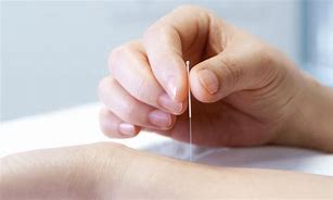 Image result for Chinese Medicine Acupuncture