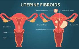 Image result for Hysterectomy Fibroids