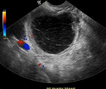 Image result for 6 Cm Cyst On Ovary