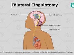 Image result for cingulotomia