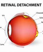 Image result for What Is a Detached Retina in the Eye