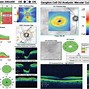 Image result for Retinal Thinning
