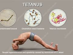 Image result for Tetanus