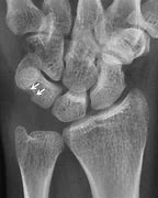 Image result for Giant Cell Tumor Wrist