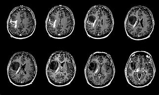 Image result for Brain Tumor Imaging