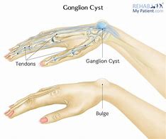 Image result for Ganglion Cyst