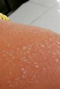 Image result for Itchy Spots After SunBurn
