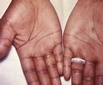 Image result for Syphilis Rash On Hands