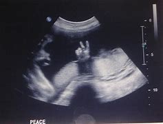 Image result for Anencephaly 8 Week Ultrasound