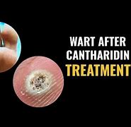 Image result for Cantharidin Wart Remover
