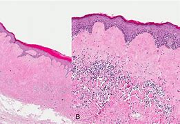 Image result for Hirsuties Papillaris Genitalis