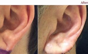 Image result for Crease On Earlobe as Sign of Heart Disease