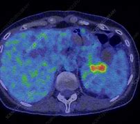Image result for Advanced Pancreatic Cancer