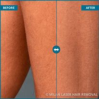 Image result for Philips Lumea Laser Hair Removal