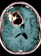 Image result for Brain Cancer CT Scan