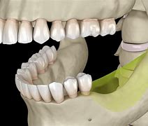 Image result for Front Teeth Bone Loss