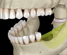 Image result for Jawbone Deterioration and Ripping