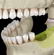 Image result for Jaw Bone Loss in Seniors