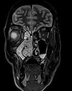 Image result for Inverted Papilloma Radiology