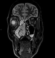 Image result for Inverted Papilloma CT Scan