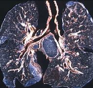 Image result for Tar Diseased Lungs
