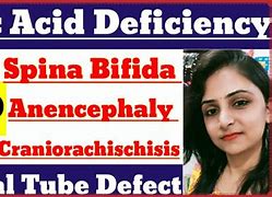 Image result for Anencephaly Valrpoic Acid